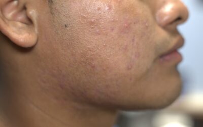 Clearer Skin from Within: How INDIBA is Revolutionizing Acne Treatment